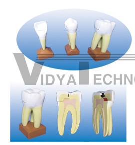 The dissection model of maxillary 3roots caries (2 parts)